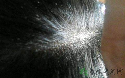 什么是脂溢性皮炎_医学健康_养生之道网